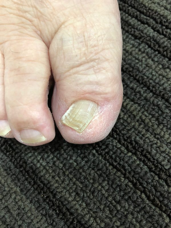 巻き爪と手術のその後