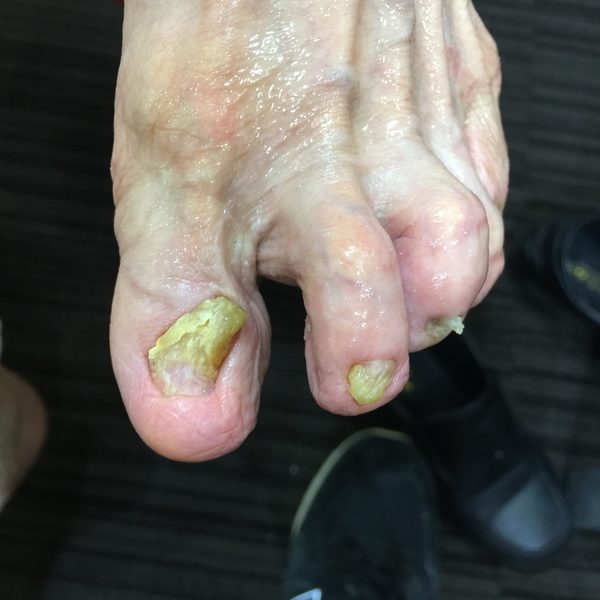 看護師さんと爪の問題解決