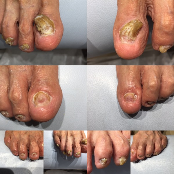 肥厚爪、鉤彎爪はなぜいけないのか？