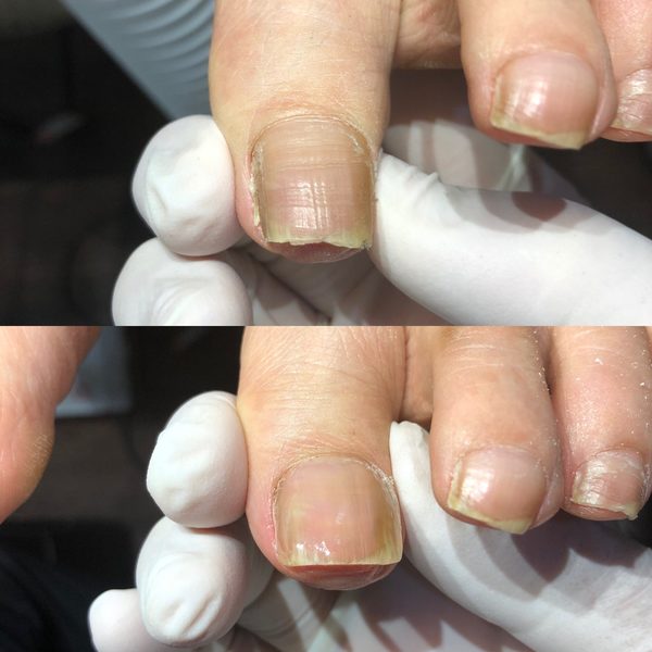 巻き爪の両側上げ動画