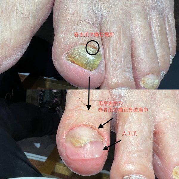 変形した爪・肥厚した爪の処置例