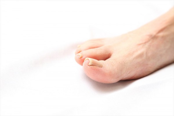 巻き爪の再発を防ぐ！効果的な予防方法とケアのポイント