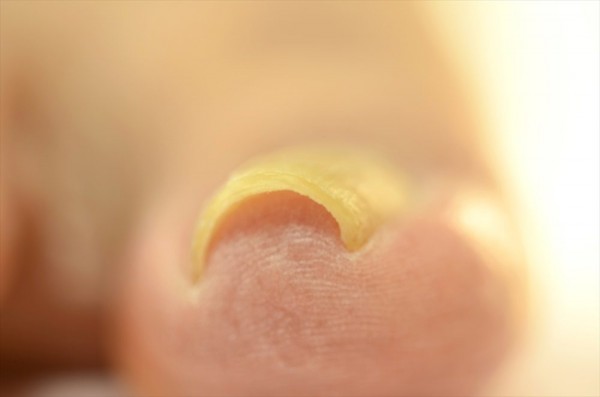 巻き爪を病院以外で自然治療する方法と注意点