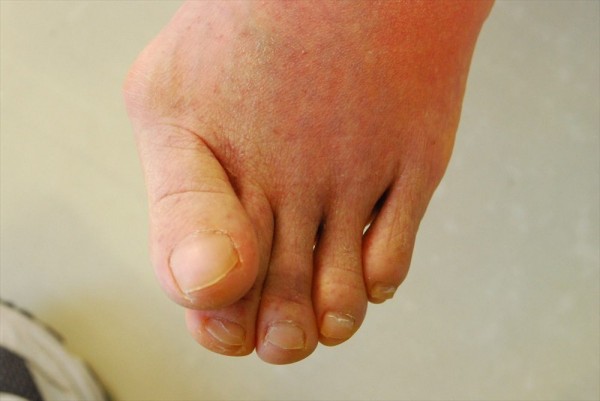外反母趾の原因とは？予防法や改善策も徹底解説！