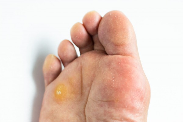 足のタコができる原因とは？予防法と改善策を徹底解説！