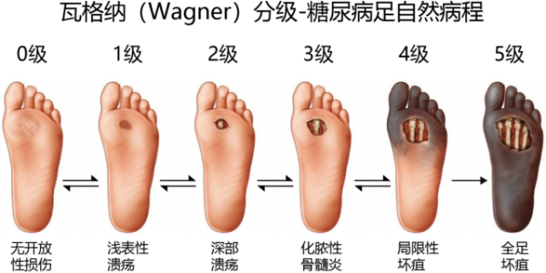 やっぱり怖い糖尿病の足病変